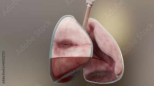 3d Illustration of Hemopneumothorax, Normal lung versus collapsed, symptoms of Hemopneumothorax, pleural effusion, empyema, complications after a chest injury, air in the pleural space, 3d Render photo