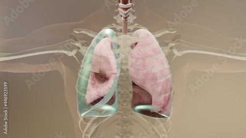 3d Illustration of Pneumothorax, Normal lung versus collapsed, symptoms of pneumothorax, pleural effusion, empyema, complications after a chest injury, air in the pleural space, 3d Render photo