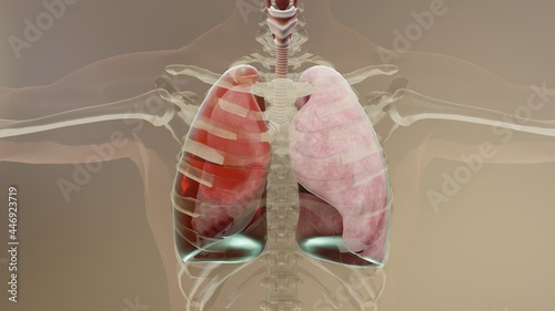 3d Illustration of Hemothorax, Normal lung versus collapsed, symptoms of Hemothorax, pleural effusion, empyema, complications after a chest injury, air in the pleural space, 3d Render photo
