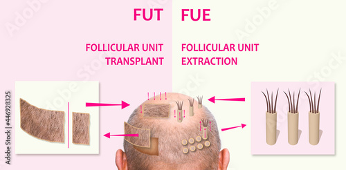Methods of hair transplantation fut vs fue with infographic elements of illustration. photo