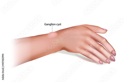 Ganglion Cyst of the Wrist and Hand. Synovial cyst or a Gideon s Disease, or a Bible Cyst, or a Bible Bump. photo