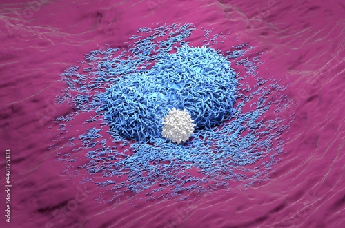 Liver cancer hepatoma blue color with t-cell realistic isometric view 3d illustration photo