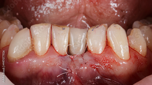 Temporary crown after implantation on the lower jaw