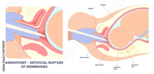 Labor swept drug baby Foley Strip sweep sac uterus hook Amnio fetus risk Cook ripe IV line bulb speed up plug mucus previa water vagina ripen first gland loop birth give method induce cervix sweeping