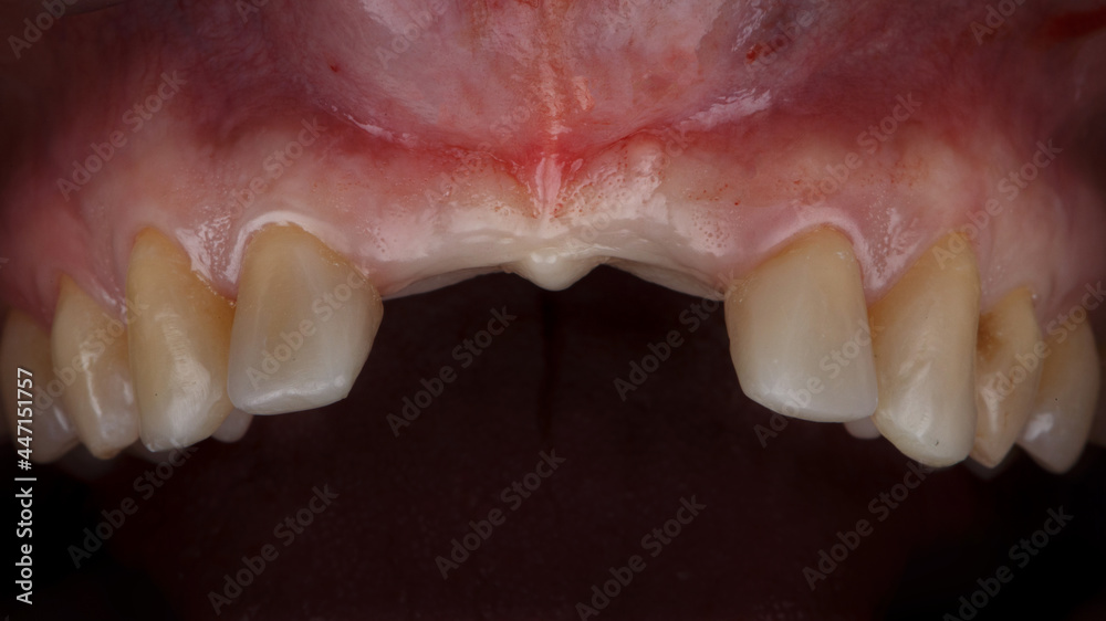 Obraz premium oral cavity without two teeth of the upper jaw on a black background