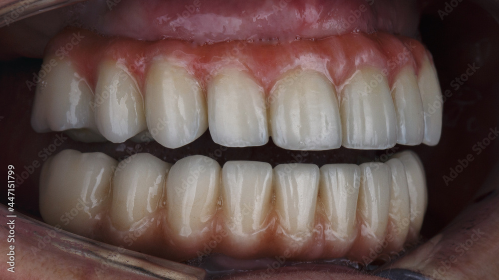 Dental High quality prostheses for both jaws in an open state in the patient's mouth Dental High quality prostheses for both jaws in an open state in the patient's mouth