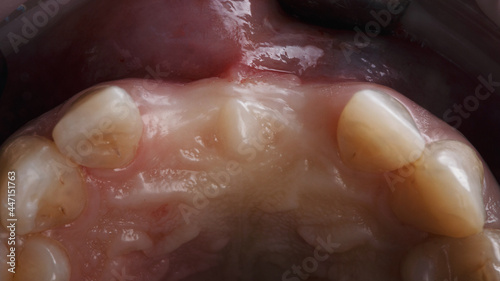 The cavity of the gums in occlusion without two central teeth before implantation