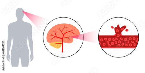 Brain stroke hemorrhagic
