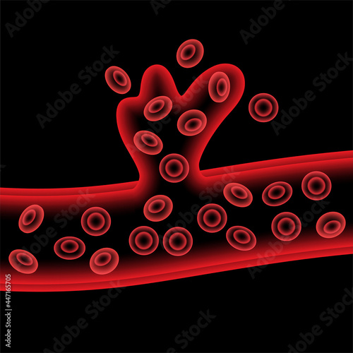 Brain stroke hemorrhagic