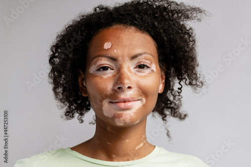Young woman with vitiligo posing while looking at camera photo