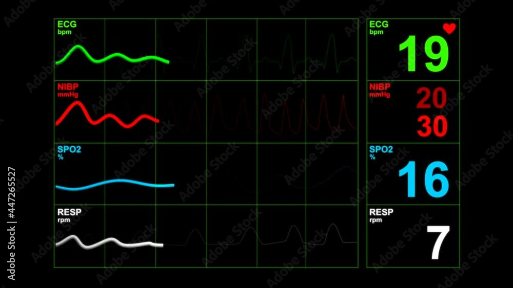 Heart rate monitor in hospital theater. Medical vital signs monitor instrument in a hospital on anesthesia surgery monitor. ECG. Patient heartbeat at the screen