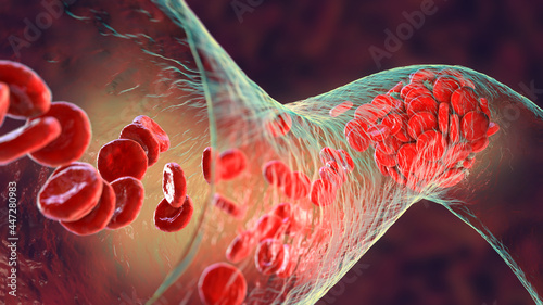 Blood clot made of red blood cells, platelets and fibrin protein strands