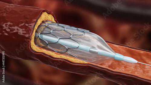 Angioplasty 3D rendering illustration. Stent delivery with dilated balloon within a diseased artery or blood vessel clogged by cholesterol or atheroma plaque. Surgery, medicine, cardiology concepts. photo
