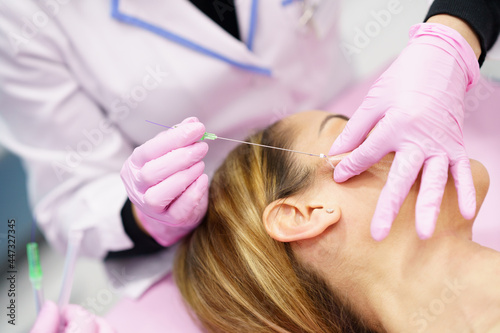 Tablou pe pânză Doctor injecting PDO suture treatment threads into the face of a woman