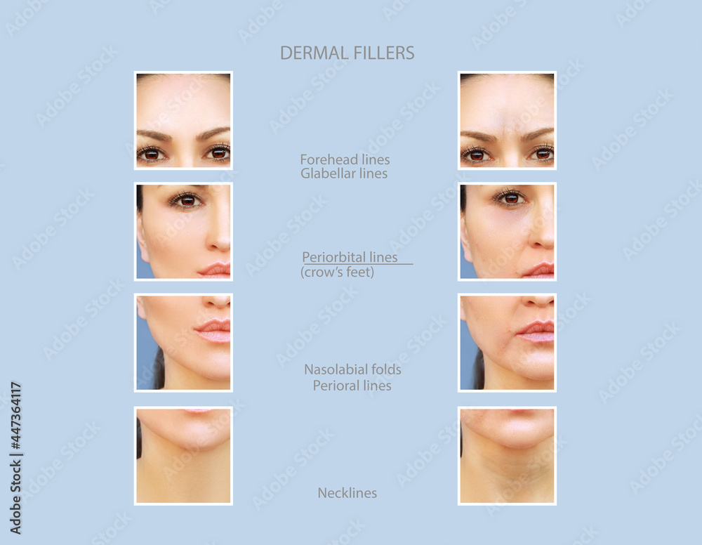 dermal filler treatments .Hyaluronic acid injections for specific areas
