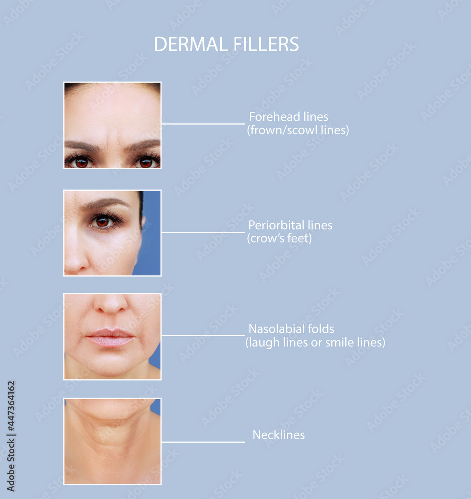 dermal filler treatments .Hyaluronic acid injections for specific areas