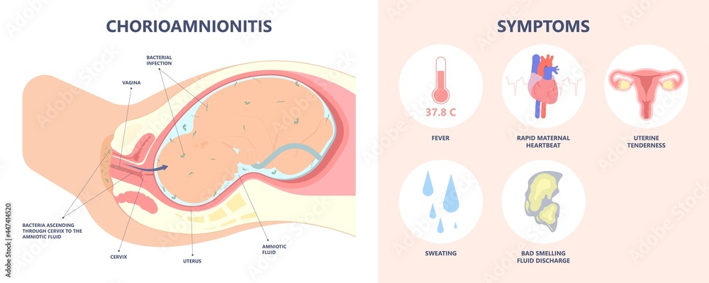 Obraz premium sepsis birth preterm atony baby intra bacteria women water breaks labor fetus fluid mother poly microbial disease urinary tract E. coli genital vagina uterus health Group B Strep amnion Fetal system