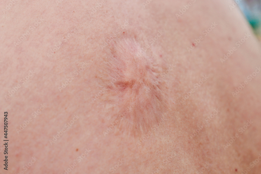 scar from removal of papilloma on the back of a person.