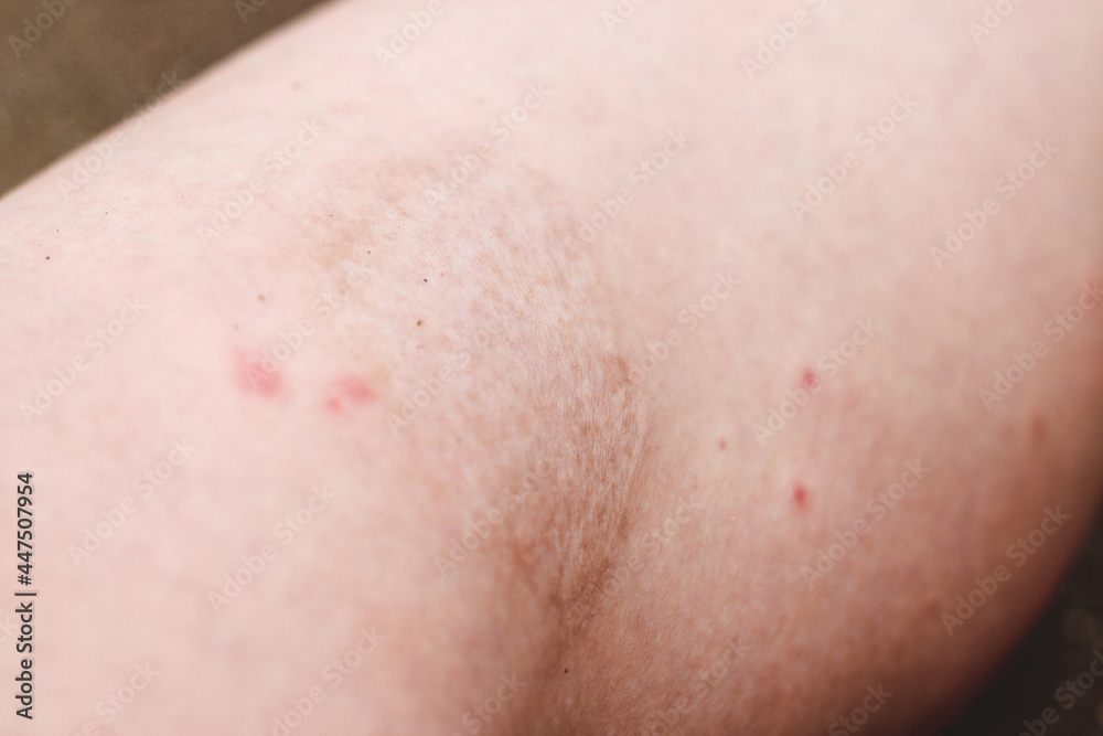 a large scar on the leg from a burn after 3 years. a large scar on the leg from a burn after 3 years.