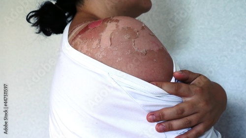 the bare shoulder of a dark-skinned woman with traces of healing wounds from severe sunburn, a girl in white clothes showing sun-damaged skin on a burnt shoulder, burn scars on her body