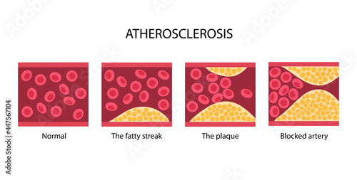 Cholesterol and atherosclerosis
