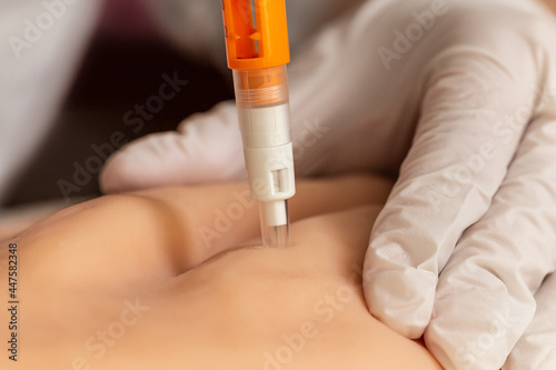 Close-up of a subcutaneous injection with an insulin pen syringe  photo