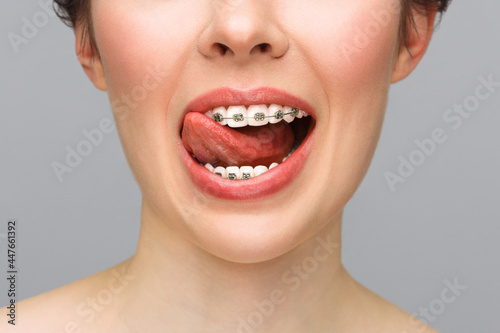 Orthodontic Treatment. Dental Care Concept. Closeup Ceramic and Metal Brackets on Teeth. Beautiful Female Smile with Braces.