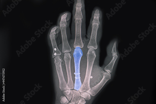 Hand xray showing spiral fractured third metacarpal bone photo