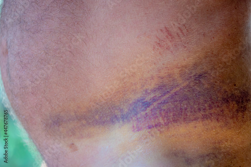 Close up waist or rib of a man with blue and scratch on skin, Bruise is a common skin injury that results in a discoloration of the skin, Blood from damaged blood cells deep beneath the skin collects.
