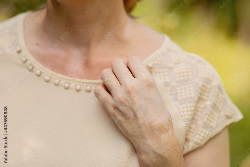 Hand skin pigmentation. White-brown leather. Melasma. Benign pigmentation. Hormonal Disorders. Medical concept. Hand skin pigmentation. White-brown leather. Melasma. Benign pigmentation. Hormonal Disorders. Medical concept.