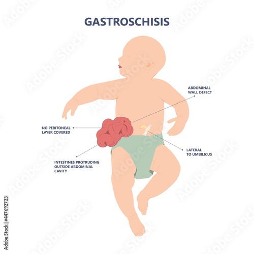 Gastroschisis Omphalocele usmle hernia birth defect silo wall fetus fluid organ bowel born abdomen baby care short unit cord belly repair hole infant gene test fetal rare sac neonate NICU C section