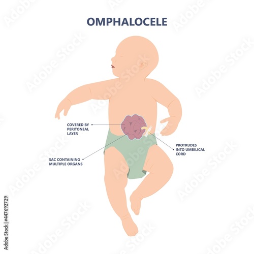 Gastroschisis Omphalocele usmle hernia birth defect silo wall fetus fluid organ bowel born abdomen baby care short unit cord belly repair hole infant gene test fetal rare sac neonate NICU C section