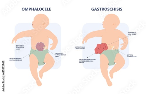 Gastroschisis Omphalocele usmle hernia birth defect silo wall fetus fluid organ bowel born abdomen baby care short unit cord belly repair hole infant gene test fetal rare sac neonate NICU C section photo