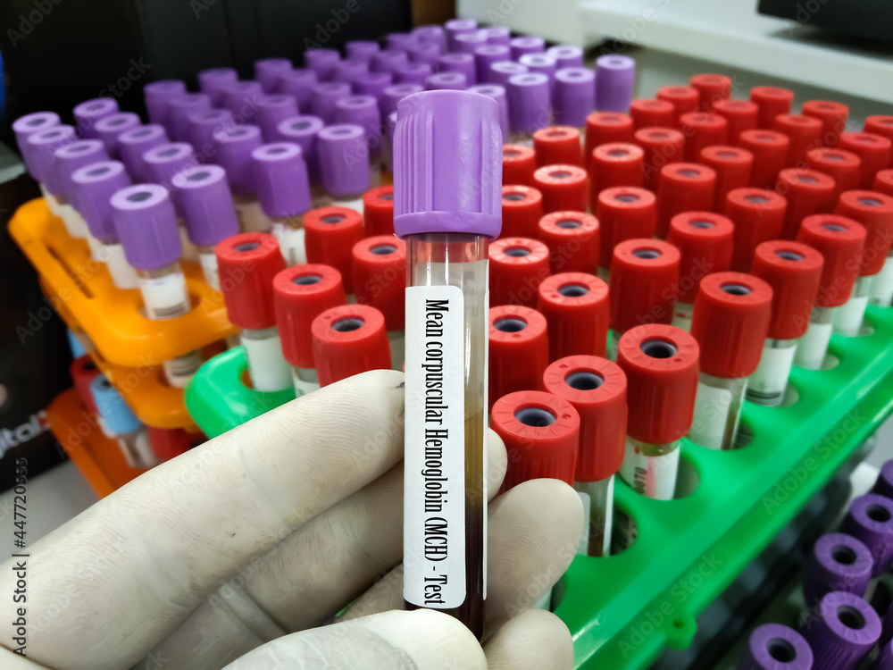 Doctor holding blood sample tube ForCBC, Hemogram,HCT, MCV Hematrocrit