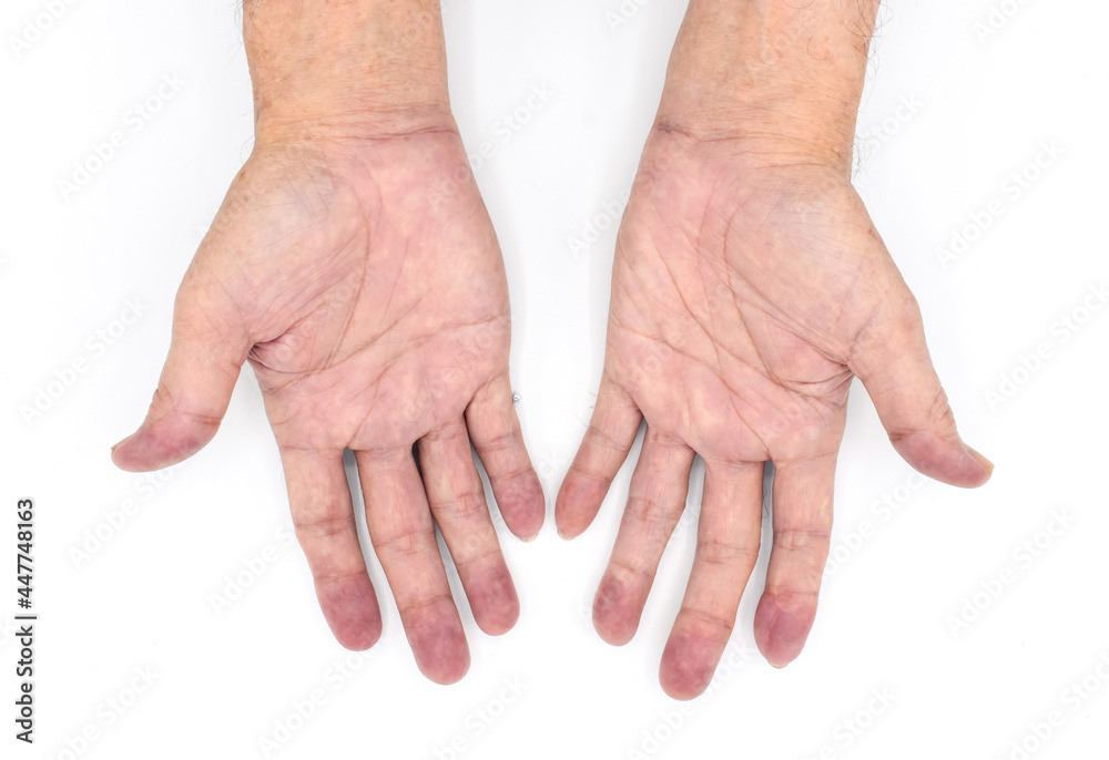 Identitet servitrice Justering Cyanotic hands or central cyanosis or blue hands at Asian young man with  congenital heart disease. Stock-foto | Adobe Stock