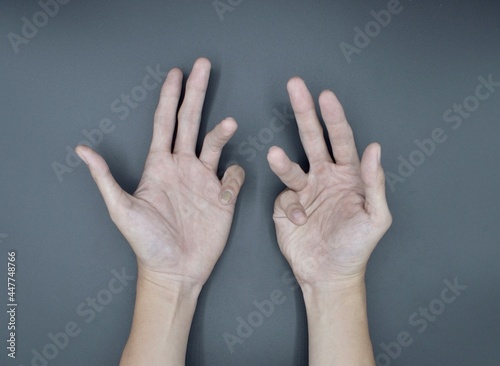 Bilateral Dupuytren’s contracture in Asian young man. Bilateral hand deformities. Abnormal fingers flexion. © ZayNyi