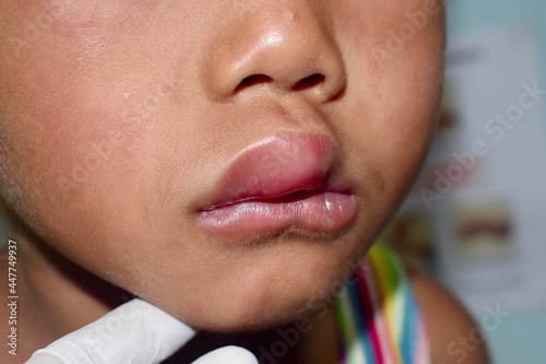 Angioedema at lips of Asian male child. Edematous child. Caused by drug, seafood or chemical allergy and insect bite. Lateral view. photo