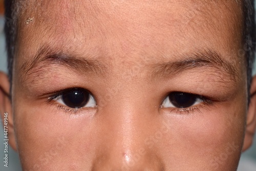 Angioedema at eyelids of Asian male child. Puffy face. Edematous child. Caused by nephritis, nephrotic syndrome, drug, seafood or chemical allergy and insect bite. photo