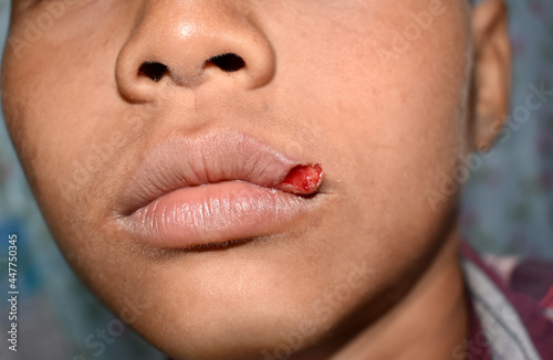 Small lacerated wound in lip of Asian, child.