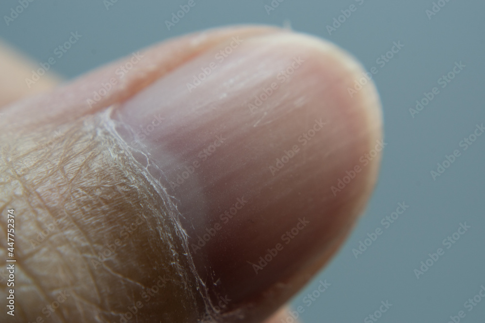 Foto de Dry skin, dry fingernails, flaky nose and nails. do Stock