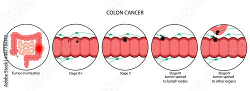 Colon cancer stage