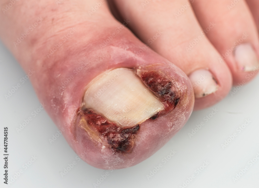 ingrowing toenail ingrowing toenail