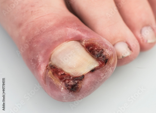 ingrowing toenail photo