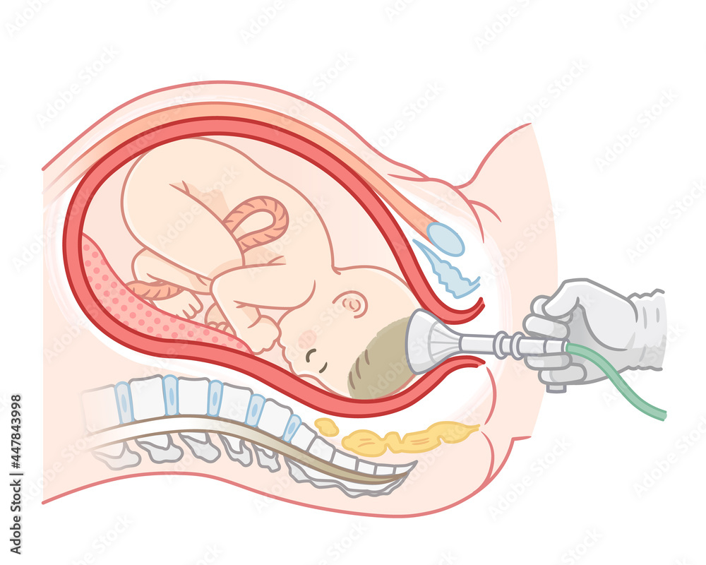 吸引分娩の胎児のイラスト Stock ベクター Adobe Stock