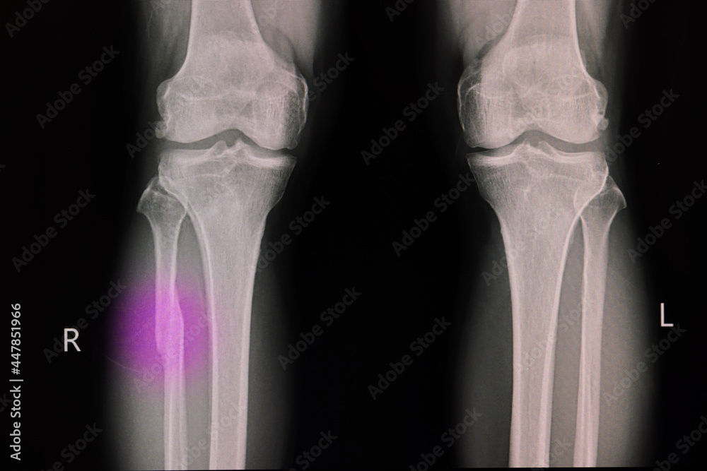 X -ray film of a knee of a patient with fractured proximal fibula X -ray film of a knee of a patient with fractured proximal fibula