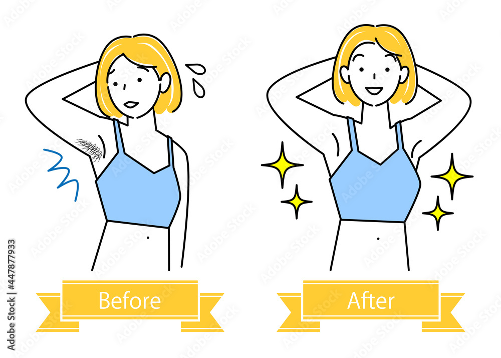 ムダ毛処理 わき毛を脱毛する可愛い女性のビフォーアフター イラスト シンプル ベクター Unwanted Hair Treatment Before And After Of A Pretty Woman Removing Armpit Hair Simple Illustration Vector Stock Vector Adobe Stock