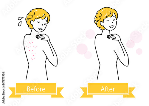スキンケア 背中の肌荒れのビフォーアフター 可愛い女性のイラスト シンプル ベクター