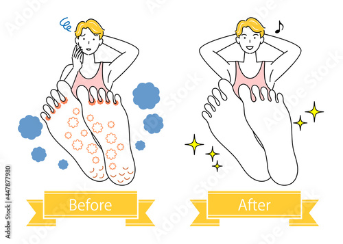 スキンケア 水虫 足裏のお肌トラブルのビフォーアフター 可愛い男性のイラスト シンプル ベクター