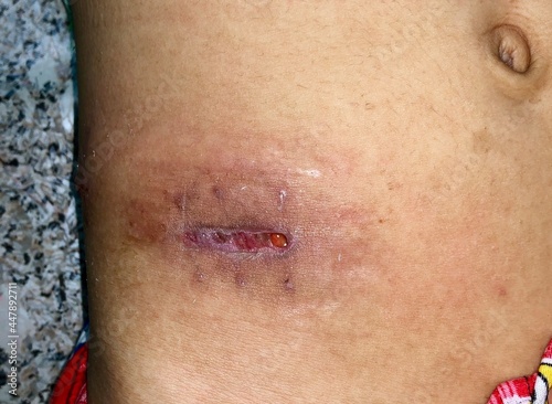 Poor wound healing due to wound gapping. Incision for appendectomy. Surgical wound infection.