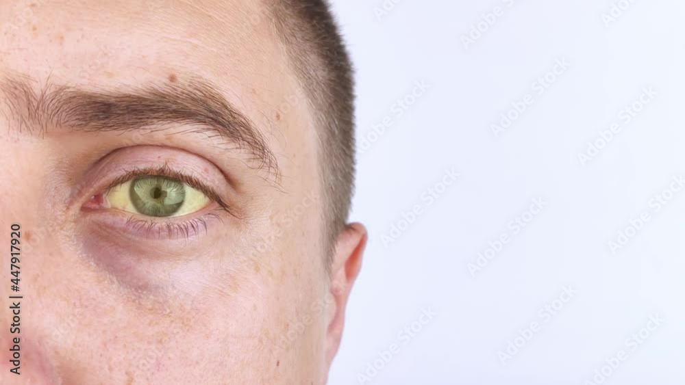 Stockvideon The yellow color of the man eye. Symptom of jaundice